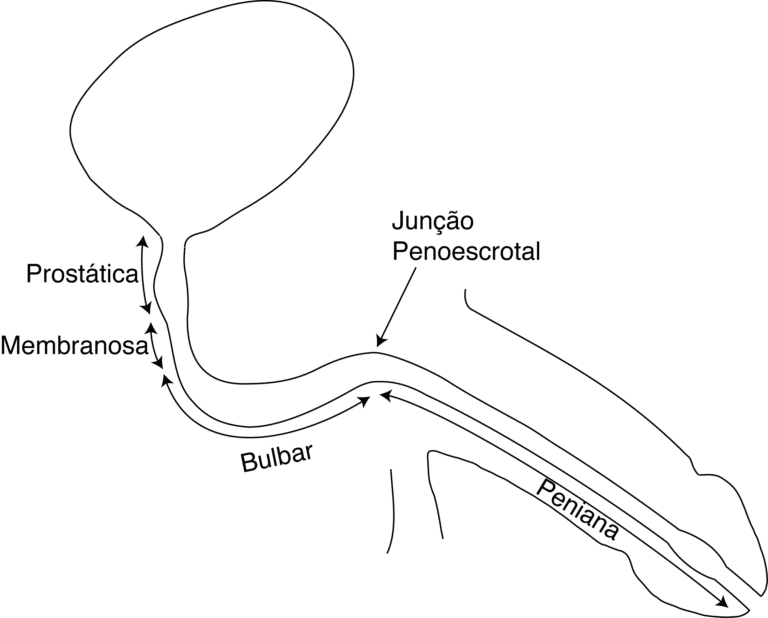 Estenose De Uretra Dr Alexandre Miranda Andrologia And Urologia 8229